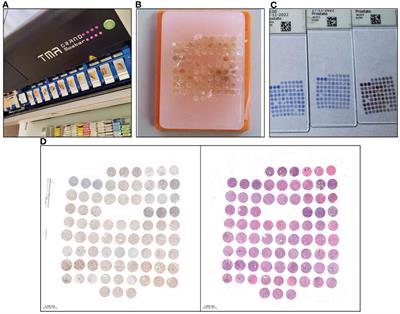 Comparative analysis of GOLPH3 expression in lymph node-positive prostate cancer: immunohistochemistry staining patterns and clinical significance